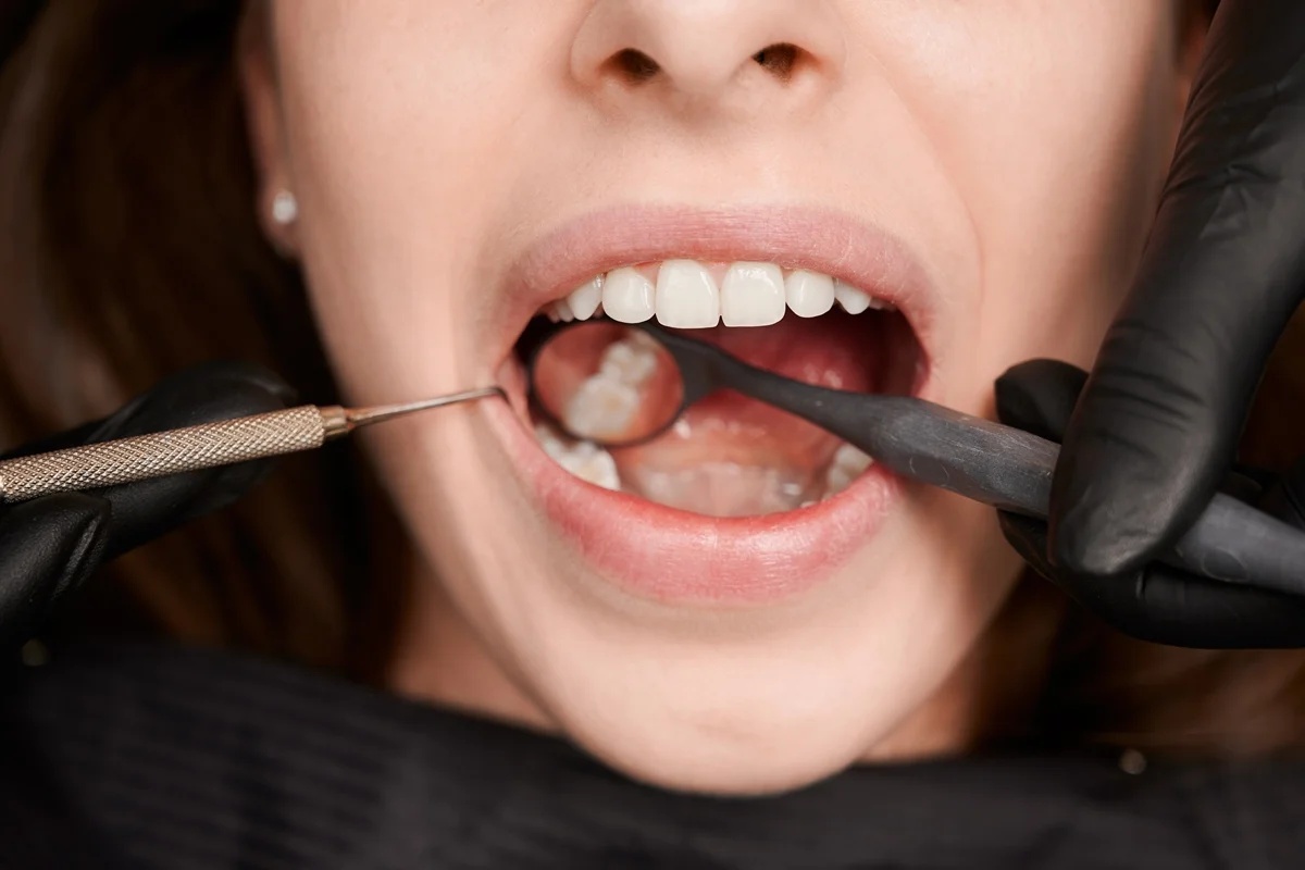 Pesquisa desenvolve gel dental capaz de regenerar esmalte dentário afetado por cáries