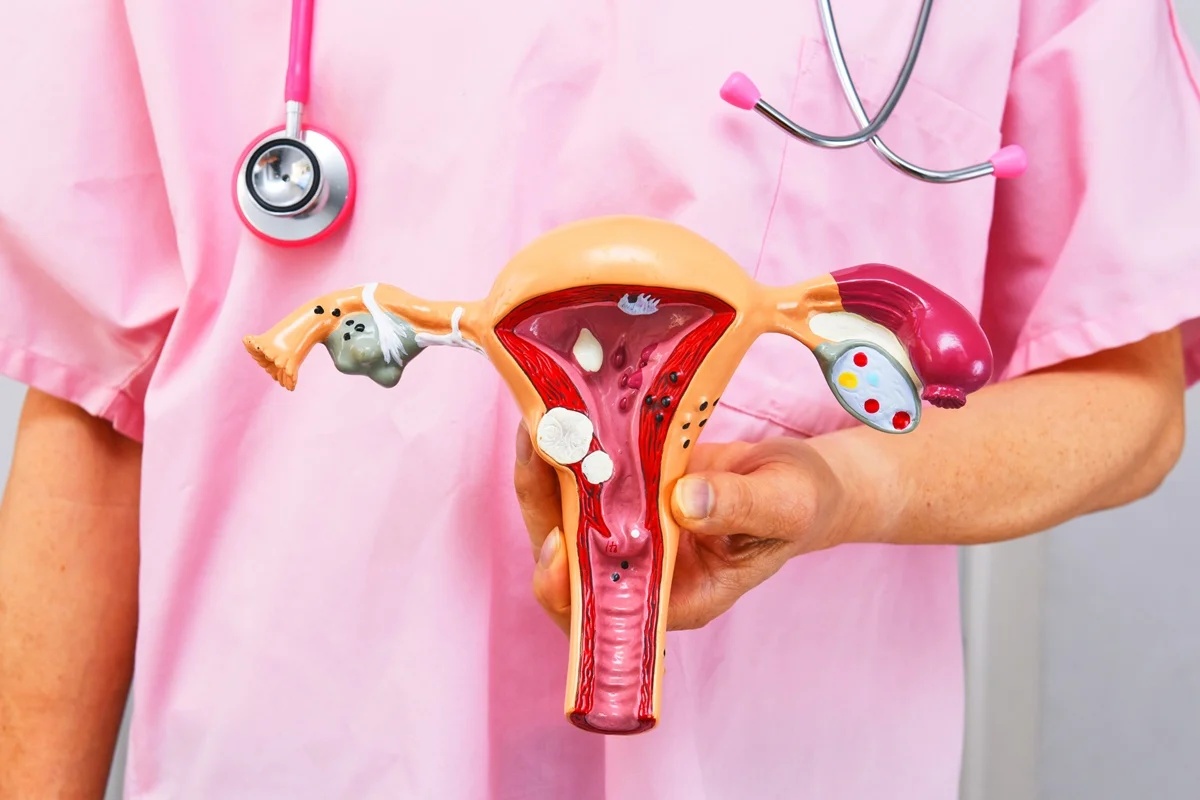 Planos de saúde passam a incluir cobertura obrigatória para DIU hormonal no tratamento de endometriose