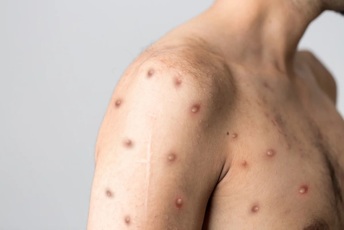 Rio de Janeiro registra 74 casos de Mpox entre setembro e outubro