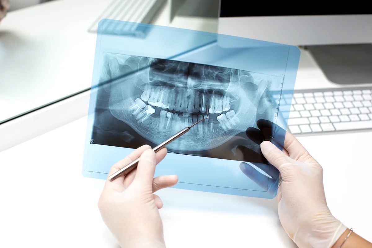 Estudo identifica presença de 19 substâncias químicas em dentes de crianças com autismo