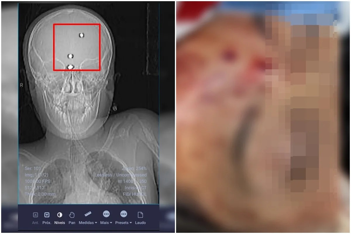 Menino baleado por arma de pressão deixa a UTI após mais de duas semanas de internação em Goiânia