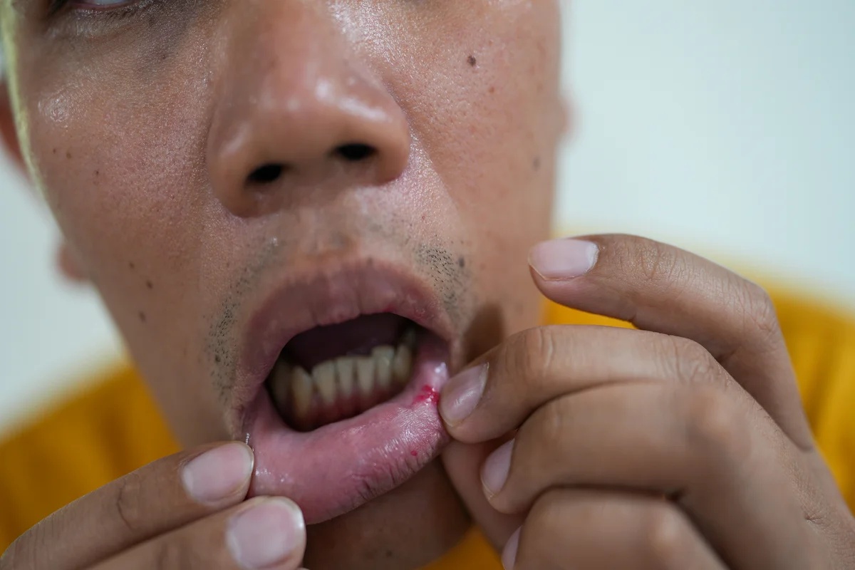 Uso de laserterapia e cuidados nutricionais contribuem para controle da mucosite oral em pacientes oncológicos