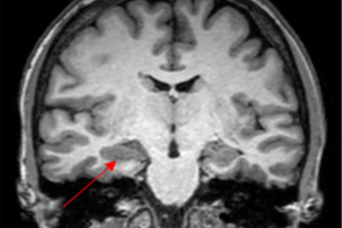Caso de convulsões menstruais leva à suspeita de endometriose cerebral e tratamento bem-sucedido